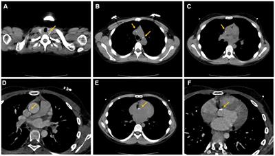Case report: Multiple arterial stenoses induced by autosomal-recessive hypophosphatemic rickets type 2 associated with mutation of ENPP1: a case study